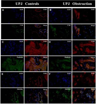 Expression and clinical implications of PARs in the stenotic tissue of ureteropelvic junction obstruction